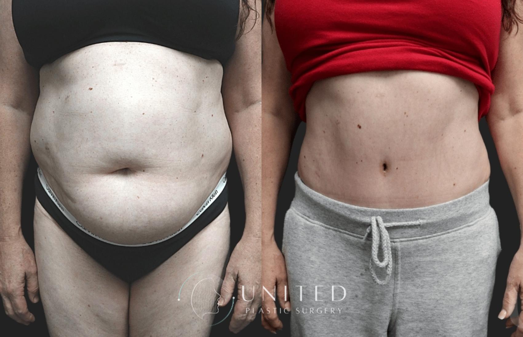 Before & After Tummy Tuck Case 8 Front View in Newport Beach, Temecula, & Orange County, California