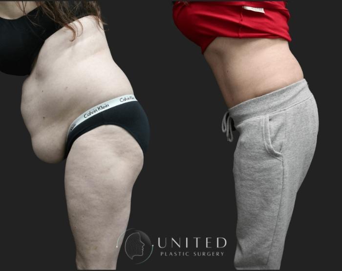 Before & After Liposuction Case 8 Left Side Bent At Waist View in Newport Beach, Temecula, & Orange County, California