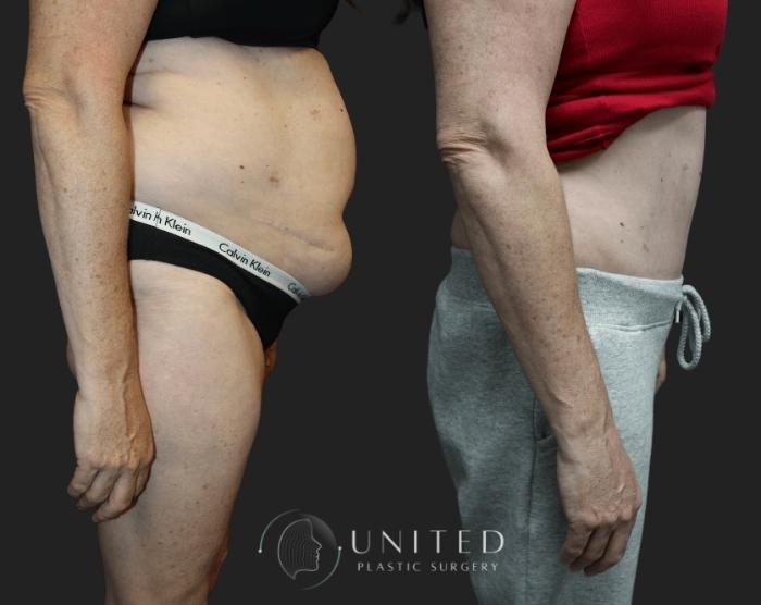 Before & After Liposuction Case 8 Right Side View in Newport Beach, Temecula, & Orange County, California